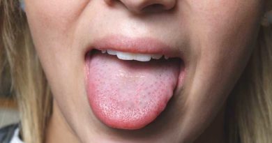 home remedies for sore tongue
